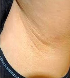 Antes e depois do clareamento de axila 2